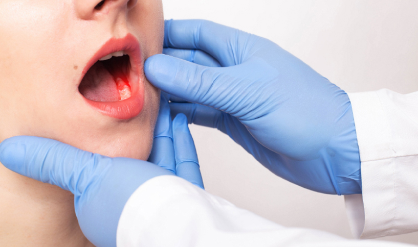 Claves Para La Detección Precoz Del Cáncer Oral En La Consulta Dental Cuida Tus Encías Cuida 